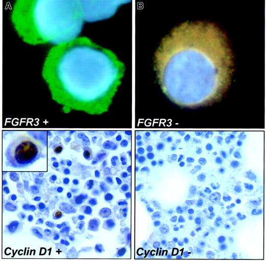Fig. 2. Genetic up-regulation of FGFR3 and cyclin D1. / The left upper panel shows a PC with the intense cytoplasmic fluorescence for the FGFR3 (FITC) and is counterstained with DAPI. This patient had a t(4;14)(p16.3;q32) detected by cIg-FISH. The PC in the upper right panel shows no reactivity to the FGFR3antibody (no t(4;14)(p16.3;q32) detected by cIg-FISH). The lower left panel depicts a PC with intense nuclear positivity for cyclin D1 by immunohistochemistry (light H-E counterstain). This patient also had the t(11;14)(q13;q32) detected. Inset shows nuclear localization in enlarged cell. The lower right panel shows a PC of a patient negative for cyclin D1 and for the t(11;14)(q13;q32) by FISH (100 × magnification, Leica DMRXA microscope).