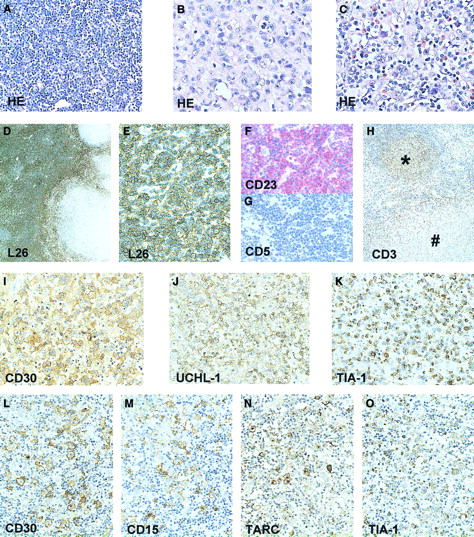 Fig. 1. Immunohistochemical staining of the lymph node involved with CLL, ALCL, and HL. / HE-stained tissue section showing the CLL component (A); ALCL component (B); and the Hodgkin component with R-S cells, small lymphocytes, and eosinophils (C). CLL component (D-H), CD20 (L26) staining showing predominance of CD20+ CLL cells (D,E), and CLL area staining positive for CD23 (F) but negative for CD5 (G). Presence of many CD3+ T cells in Hodgkin nodule (*) and absence in surrounding CLL area and in ALCL component (#) (H). ALCL component showing presence of CD30 (I), UCHL-1 (CD45RO) (J) and TIA-1 (K)–positive cells. HL component showing presence of CD30 (L), CD15 (M), TARC (N), and TIA-1 (O)–positive R-S cells. Original magnifications: × 25 (D); × 50 (H); × 200 (A,E-G,L-O); × 400 (B,C,I-K).