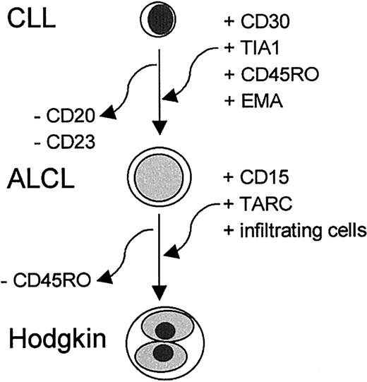 Fig. 3. A schematic representation of the cumulative changes detected in transformation from CLL to ALCL and to HL components.