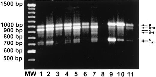 Fig. 1. Leukemic LGLs express high levels of variant gene transcripts representing soluble Fas. / RT-PCR analyses of the Fas mRNA were performed by synthesizing cDNA with oligo dT and performing PCR amplifications with primers described in “Patients, materials, and methods.” The full-length Fas mRNA is a predicted 1009–base pair (bp) (195-1203) fragment. Lanes 1-7, unstimulated PMBCs from LGL leukemia patients; lane 8, negative control; lane 9, Jurkat cells; lane 10, normal PHA/IL-2–activated PBMCs; lane 11, unstimulated normal PBMCs. Arrow a represents full-length Fas mRNA, and arrows b through i represent alternatively spliced mRNA.