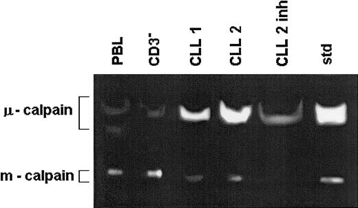 Fig. 3. The activity of μ-calpain is increased while that of m-calpain is reduced in the B-CLL cells compared with B cells of healthy people. / Lysates of peripheral blood lymphocytes and immunomagnetically enriched B cells (CD3−) of a healthy 67-year-old and of the same number of B-CLL cells from 2 age-matched patients (CLL 1, CLL 2) were prepared in PBS and tested by zymography. The lysate treated with calpain inhibitor II served as specificity control (CLL 2 inh). Std indicates the activities of standard μ- and m-calpain as in Figure 1. This is a representative zymogram of 1 of 5 experiments giving similar results. The inhibitory effects of calpain inhibitor II, calpeptin, and rabbit muscle calpastatin were similar.