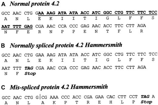 Fig. 2. The 41-bp frameshift deletion (nucleotides 1709-1749) in the 5′ end of exon 11 protein 4.2 cDNA. / (A) Normal protein 4.2 cDNA sequence shown between nucleotides 1699-1779 (numbered according to Sung et al2). (B) The equivalent sequence in protein 4.2 Hammersmith, correctly spliced and containing the 1747G>T mutation (revealed by genomic DNA sequencing, as shown in Figure 4). The 1747G>T mutation introduces a Glu583→Stop substitution. (C) The equivalent misspliced sequence in protein 4.2 Hammersmith is shortened by the 41-bp frameshift deletion (bold and underlined characters in the control), which alters the reading frame and introduces a stop codon (TAG) as the ninth full codon of the frameshifted region following the deletion.