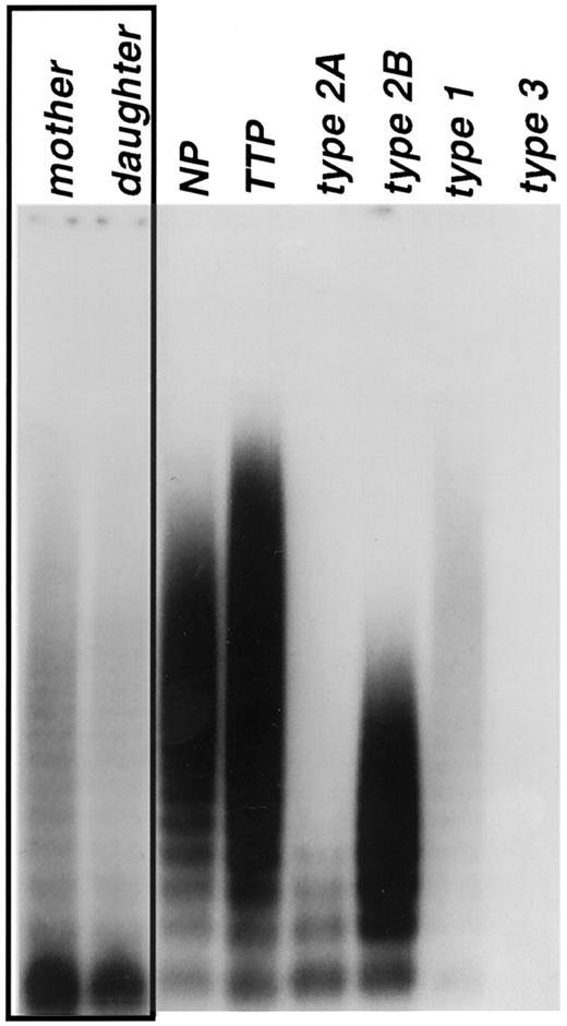 Fig. 1. Unique multimeric structure of patient's plasma VWF. / Plasma samples were obtained from the patient and a family member (mother and daughter, respectively) and 5 VWD controls, analyzed by means of agarose gel electrophoresis (1% agarose), and detected by Western blot with AVW-5 and AVW-17. Control plasma samples included normal pool plasma (NP, lane 3); thrombotic thrombocytopenic purpura (TTP, lane 4); and type 2A (lane 5), type 2B (lane 6), type 1 (lane 7), and type 3 (lane 8) for typing comparisons. Plasma samples obtained from the mother and daughter are shown in lanes 1 and 2. The VWF multimeric patterns of both patients (lanes 1 and 2) do not resemble any of the known type 2 VWD multimeric patterns.