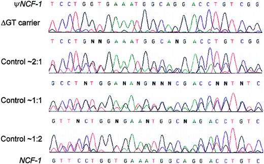 Fig. 2. Sequencing electropherograms distinguish among 3 differentψNCF-1/NCF-1 genotypes in the normal population, as well as carriers of the common NCF-1 ΔGT mutation. / Genomic DNA from control individuals unaffected by CGD and obligate carriers of A47°CGD was amplified using primers 2LB2 and 2RB2, which do not distinguish between NCF-1 and ψNCF-1.The figure shows representative electropherograms that cover a 27-bp stretch starting 9 nucleotides downstream from the start of exon 2 (ie, nucleotides 81-107 of the NCF-1 cDNA). In each case, double sequence is observed because it diverges after the initial GT at the start of the exon (not shown). The nucleotide sequences of the pseudogenes and functional gene are shown at the top and bottom of the figure, respectively. Unaffected control individuals fell into 3 distinct groups with approximate ΔGT/GTGT sequence ratios of 2:1, 1:1, and 1:2, as shown, based on peak height measurements. This is well illustrated, for example, by the G (ψNCF-1) and C(NCF-1) at the fifth position. Most obligate carriers of the ΔGT mutation had a much higher ratio of ΔGT (pseudogene) sequence, as seen in the top electropherogram.