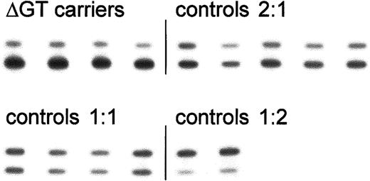 Fig. 4. Analysis of the ratio of ΔGT- to GTGT-containing sequence based on PCR product size. / 32P-labeled PCR products encompassing the start of exon 2 from control individuals and carriers of the ΔGT mutation were separated on denaturing acrylamide sequencing gels. Bands were detected by autoradiography (as shown here) or in a Cyclone storage phosphor system. The upper (100 bp) and lower (98 bp) bands represent fragments containing the functional GTGT or the ΔGT mutation, respectively. Results from a single representative experiment are shown; mean values for each group are presented in Table 1.