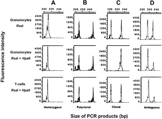 Fig. 1. Clonality analysis using the HUMARA-PCR assay with a fluorescein-labeled primer. / Top row: DNA from granulocytes digested with RsaI. Middle row: DNA from granulocytes digested with RsaI andHpaII. Bottom row: DNA from T cells digested withRsaI and HpaII. After digestion of DNA with the restriction enzymes, the area under the curve was calculated for each allele by using Genescan software. (A) Homozygous XCIP. (B) Polyclonal XCIP. (C) Monoclonal XCIP. (D) Ambiguous XCIP.