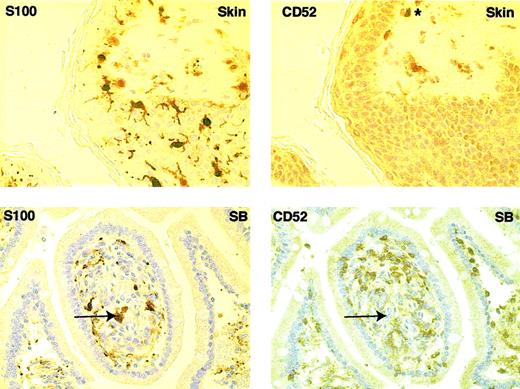 Fig. 6. Expression of CD52 by tissue dendritic cells. / Staining of adjacent sections of normal skin and small bowel (SB) with S100 and CD52 show that DCs in these tissues do not express CD52. Langerhans cells stain positively for S100 but are uniformly negative for CD52. A normal lymphoid cell in the CD52-stained skin section is shown (*). A DC in a sample of small intestinal mucosa is similarly stained with S100 but not CD52 (indicated by the arrow). Original magnification, × 400.