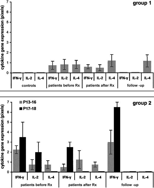 Fig. 1. Ex-vivo Th1/Th2 cytokine gene expression profiles in patients with ITP versus healthy pediatric controls. / PBMCs were isolated from the patients and controls and RNA was extracted immediately (ex vivo). RT-PCR was performed and the results were quantified and given as pixels/102 ± SEM (as described in “Patients, materials, and methods”). Panel A shows 14 healthy pediatric controls (left) and group 1 ITP patients P1 to P12 with first episode followed by stable remission (gray bars); Panel B shows group 2 ITP patients P13 to P16 with first episode followed by infrequent relapses triggered by viral infection (gray bars) and ITP patients P17 and P18 with first episode followed by frequent episodes occurring within periods of less than 1 month, regardless of infection, requiring continuous monitoring (black bars). Before Rx indicates at presentation; after Rx, 24 hours after IVIg therapy; follow-up, recall patients.