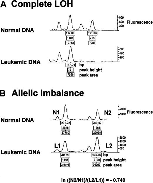 Fig. 1. Complete LOH and allelic imbalance. / Representative electropherogram tracings of microsatellite analysis from the same DNA samples of patient 39. (A) Complete LOH is present at the microsatellite marker D18S70. (B) Allelic imbalance at D17S921 with an allelic ratio of −0.749 (Figure 2). ln = natural log.
