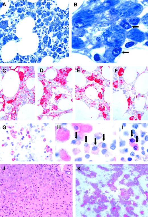 Fig. 1. CSH in the bone marrow and the liver. / (A,B) Initial bone marrow biopsy. (A) Bone marrow shows a diffuse infiltrate of histiocytes stuffed with crystalloid inclusions (Giemsa, × 1600). (B) Plasma cells (marked by arrows) are only rarely admixed (Giemsa, × 4000). (C-F) Immunohistochemistry reveals positive reactivity of the histiocytes not only for IgA (C) and κ (D), but also for IgG (E) and λ (F; × 1000 each). (G-I) Bone marrow at the time of autopsy. (G) Plasma cells are multiplied compared to the initial biopsies and stain immunohistochemically positively for a monoclonal plasma cell marker (× 1600). (H) Immunohistochemistry for κ light chains reveals positive reactivity in histiocytes and in plasma cells (marked by arrows). Plasma cells stain less intensely possibly due to the conformation of the produced κ light chain (× 4000). (I) They also stain positively for IgA heavy chain (× 4000). (J,K) Liver biopsy 5 months before death. (J) Swollen Kupffer cells obstruct sinusoidal spaces (H-E; × 1200). (K) The Kupffer cells are highlighted immunohistochemically by their expression of CD68 (× 2500).
