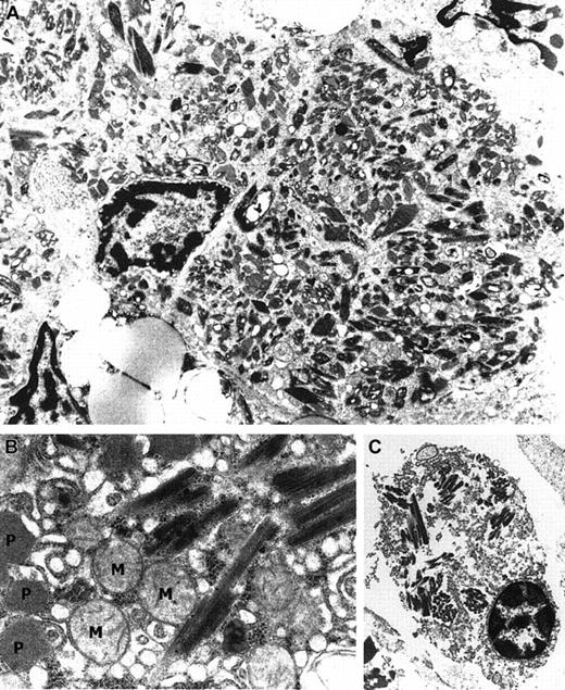 Fig. 2. Ultrastructure of different cell types containing crystalline inclusions. / (A) Kupffer cell containing rectangular and rhomboid crystals (× 10 000). (B) Similar crystalline intracytoplasmic inclusions in a hepatocyte. Note the mitochondria (M) and characteristic peroxisomes (P; × 21 000). (C) Geometrically shaped crystals in a plasma cell at the time of autopsy (× 5800).