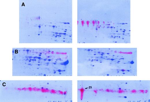Fig. 4. Immunoblot analysis. / Detection of IgA (A), IgG (B), and κ light chain (C) in soluble proteins of liver tissue probes. Immunodetection was performed on the soluble protein fraction of our patient (right) in comparison to control liver samples (left). After immunodetection, counterstaining of the spots was performed with CBB. (A) Monoclonal IgA heavy chain is detected by a set of well-resolved red spots characterized by charge microheterogeneity. (B) Polyclonal IgG heavy chains are observed as a “fuzzy” red zone, without distinct, individualized spots. (C) Monoclonal κ light chain corresponds to one dominant distinct red spot (spot 25) besides a “fuzzy” polyclonal background.