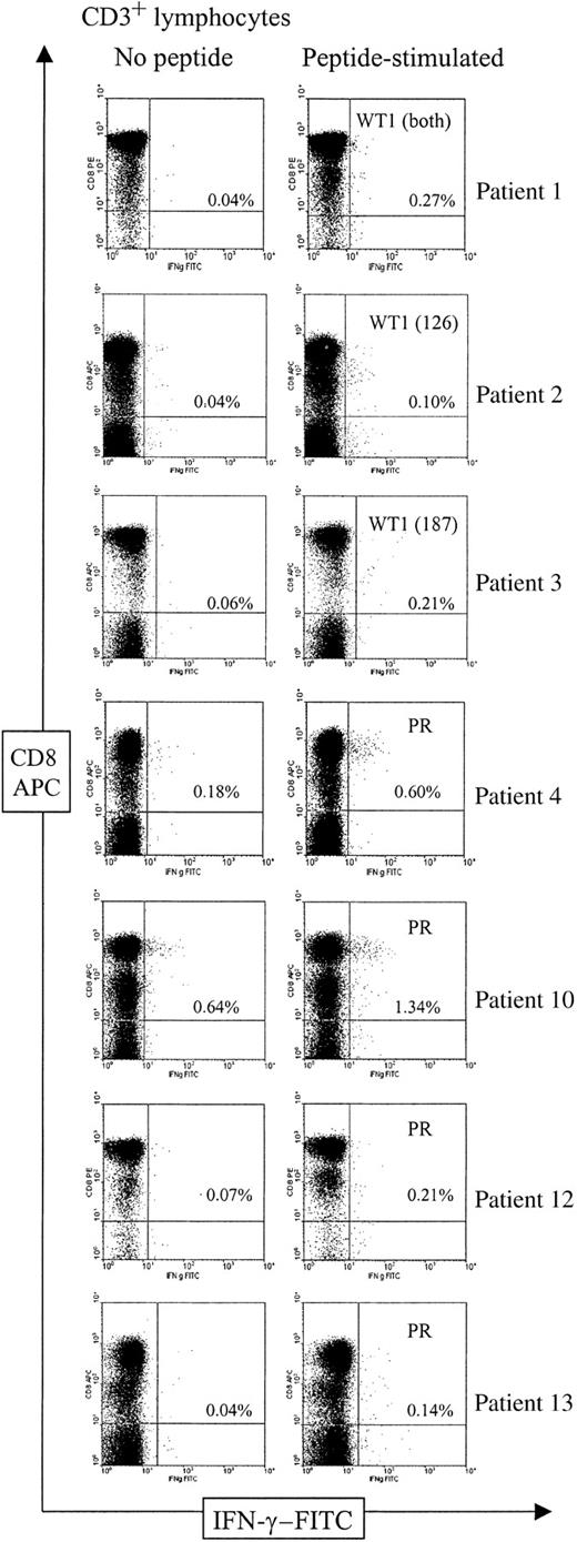 Fig. 2. Flow cytometric analysis of T-cell responses to WT1 126-134, WT1 187-195, and proteinase 3 in AML patients. / Analysis of PBMCs was performed by 3-color flow cytometry. Figures show the CD8/IFN-γ profile of CD3-gated lymphocytes in unstimulated (left) and peptide-exposed (right) PBMCs in the 7 patients with specific T-cell responses to the indicated peptides. The T-cell response in patient 1 was analyzed against both WT1 peptides in one sample. Frequencies of CD3 CD8 T cells that produced IFN-γ are shown as percentages of the total number of CD3 CD8 T cells. APC indicates allophycocyanin; FITC, fluorescein isothiocyanate.