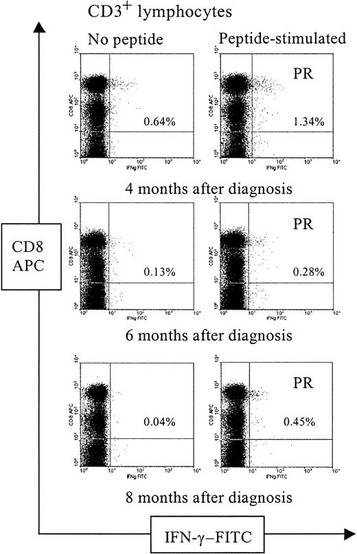 Fig. 4. Follow-up of CD3 CD8 T cells reactive with the proteinase 3 peptide in patient 10. / Analysis of PBMCs was performed by 3-color flow cytometry in patient 10 at 3 time points as indicated. Figures show the CD8/IFN-γ profile of CD3-gated lymphocytes. Frequencies of CD3 CD8 T cells that produced IFN-γ are shown as percentages of the total number of CD3 CD8 T cells.