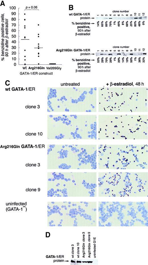 Fig. 4. Arg216Gln GATA-1 allows erythroid maturation in G1E cells. / G1E cells, which lack GATA-1, undergo erythroid differentiation after retroviral infection with GATA-1.8 Stable introduction of estrogen-receptor fusion versions of GATA-1 (GATA-1/ER) allows this differentiation to be controlled by the addition of β-estradiol, which activates the GATA-1/ER fusion protein.1929 (A) Wild-type and Arg216Gln versions of GATA-1/ER fusion proteins allow G1E cells to undergo erythroid differentiation, evidenced here by quantitation of benzidine-positive cells 90 hours after induction by β-estradiol of 12 independent clones from each group. The mean percentage of benzidine-positive cells is slightly lower in the Arg216Gln clones (t test, P = .06). No benzidine-positive cells are observed in the Val205Gly clones. (B) GATA-1/ER protein is expressed at varying levels in wild-type (top) and Arg216 (bottom) clones. Corresponding percentages of benzidine-positive cells 90 hours after induction by β-estradiol (from panel A) in individual clones are indicated below the blots. (C) Benzidine staining of clones of G1E cells following stable introduction of wild-type GATA-1/ER (the ensuing clones are named G1E-ER2) or Arg216Gln GATA-1/ER, or G1E cells alone. Benzidine-positive cells (black) are visible after β-estradiol treatment (right panels) when wt GATA-1/ER or Arg216Gln GATA-1/ER is present. Origninal magnification, × 200. (D) GATA-1/ER protein levels of clones pictured in panel C.