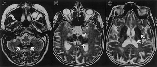 Fig. 1. Magnetic resonance images of the proband showing iron deposition in the brain. / Axial T2-weighted magnetic resonance images of the proband's brain show low-signal areas (arrows) in the dentate nucleus (A), red nucleus and substantia nigra (B), and corpus striatum and thalamus (C), which suggest iron deposition in these regions.