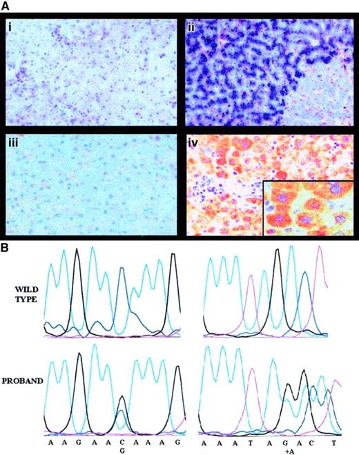 Fig. 2. Pathophysiology of aceruloplasminemia in the proband: absence of liver Cp and causal mutations. / Panel Ai shows the histology of the proband's liver (hematoxylin and eosin, × 250), with normal lobular architecture without evidence of fibrosis; Aii shows heavy iron deposition in hepatocytes (Perls colors, × 250); Aiii shows results of IHC studies with a polyclonal antibody showing absence of Cp in proband's hepatocytes (IHC, × 250); and Aiv shows Cp in normal hepatocytes (IHC, × 250). Insert is a high-power view (× 400). In (B), the left panels show a sequencing chromatograph of the proband's amplified exon 3 in the ceruloplasmin region spanning the mutation, compared with a normal control (wild-type). The right panels are a sequencing chromatograph of the proband's amplified exon 17 in the region encompassing the mutation, compared with a normal control (wild-type).