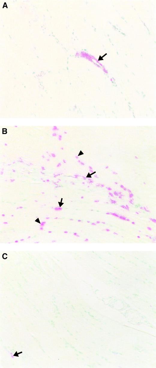 Fig. 2. Ischemia-reperfusion induces apoptosis. / Following reperfusion, muscle tissue subjected to varying periods of ischemia as a result of aortic cross-clamping followed by 3 hours of reperfusion was sectioned and stained with the TUNEL technique. Methyl green was used as a nuclear counterstain. Original magnification, × 200. (A) Minimally injured tissue with 45 minutes of ischemia (DMSO treatment) shows TUNEL positivity only in vascular endothelial cells (arrow). (B) More extensive tissue injury with 90 minutes of ischemia (DMSO treatment) with TUNEL-positive nuclei in endothelial cells (arrow) and skeletal muscle fiber cells (arrow head). (C) Pretreatment with z-VAD resulted in only a few TUNEL-positive cells in capillary endothelium of the muscle tissue subjected to 90 minutes of ischemia (arrow).