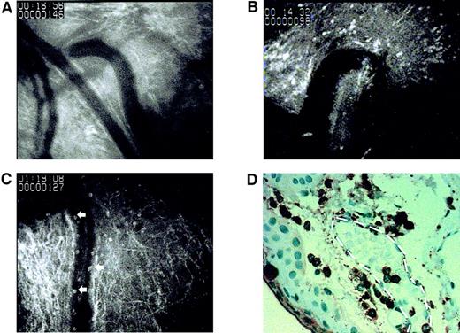 Fig. 2. Comparison of digital noninvasive video “biopsies” with classical invasive histological biopsy. / (A) Video image of conjunctival capillary from a specimen taken before the inflammation showing no rolling leukocytes near the inner surface of the vessel lined by endothelium and no leukocytes within the conjunctival stroma. (B) Strong tissue inflammation induced by local cataract surgery is visible just above the capillary diving into the surface pictured. Another hot spot of tissue-invading cells is visible at the upper right (white arrows). (C) Specimen taken during the inflammation with hydrocortisone pretreatment: capillary with several rolling leukocytes (white arrows) tethering to vascular endothelium. Several cells are visible within the tissue near the vessels. (D) A classical histological biopsy from the same patient as in panel B. Several tissue-infiltrating leukocytes stained with anti sLex antibodies (brown) are visible within the tissue; 3 intravascular leukocytes and red blood cells (blue) are depicted within a vessel cross-section marked with white dotted lines. A 1-minute video (Cataract version 2 video; size, 12 Mb; format, quick time movie) demonstrating the leukocyte rolling during inflammation in capillaries, extravasated cells within the tissue, as well as the effects of hydrocortisone on these parameters is available via the University of Helsinki Web site (http://www.helsinki.fi/science/rdd/renkonen/publications.html). Original magnification A-C, × 200; D, × 400.