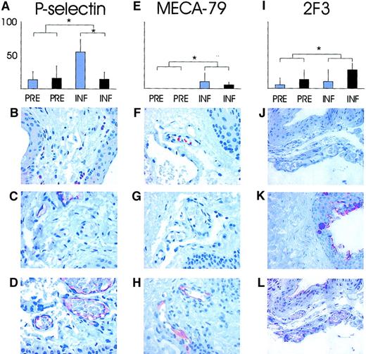 Fig. 3. Analyses of endothelial expression of P-selectin and sulfated sLex glycans on L-selectin ligands in conjunctiva. / The percentage of conjunctival venules expressing P-selectin (A); MECA-79, reactive with sulfated extended core 1 mucin–type O-glycans (E); 2F3 detecting sLex epitopes in the specimens taken before and during the inflammation without (blue bars) and with (black bars) hydrocortisone pretreatment (I). P values between the groups were calculated with Mann-Whitney U test. *P < .05. (B) (F) (J) Isotype-matched background controls visible with essentially no reactivity. (C) (G) (K) Staining of specimens taken before the inflammation where a small proportion of vessels react with anti–P-selectin antibodies (brown in panel C), but no MECA-79 reactivity is recorded. The 2F3 stains epithelial sLex, but the endothelium lining the vessels is negative. (D) (H) (L) Staining of specimens taken during the inflammation for endothelial P-selectin, MECA-79, and 2F3 with reactive endothelium within vessels (red-brown) is visible in all panels. Original magnification, × 200.