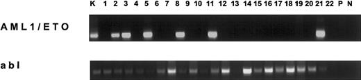 Fig. 1. Transcription of AML1/ETO in adult bone marrow from individuals without AML. / In the upper panel the 185-bp amplification product of the nested reverse trancriptase (RT)–PCR is shown in the positive control cell lineage Kasumi-1 (K) and 6 bone marrow samples of individuals without AML followed by the primary and nested negative controls (P, N, respectively). In the lower panel, the corresponding internal positive controls using an abl RT-PCR are shown. We used 2% to 3% of the total cDNA of each sample as PCR template. Goettingen primary PCR, AML1-A 5′-ACC TCAGGTTTGTCGGTCG-3′ (bp 1976 to 1974), ETO-B 5′-GAACTGGTTCTTGGAGCTCCT-3′ (bp 2211 to 2231). Goettingen nested PCR, AML1-C 5′-AAA AGCTTCACTCTGACCATCA-3′ (bp 2008 to 2029), ETO-D 5′-GGCATTGTTGGAGGAGTCAG-3′ (bp 2173 to 2192). Vienna primary PCR, AML1-1 5′-AGCCATGAAGAACCAGG-3′ (bp 1941 to 1960), ETO-1 5′-AGGCTGTAGGAGAATGG-3′ (bp 2265 to 2281). Vienna nested PCR, AML1-2 5′-TACCACAGAGCCATCAAA-3′ (bp 2062 to 2079), ETO-2 5′-GTTGTCGGTGTAAATGAA-3′ (bp 2229 to 2246). Hannover real-time PCR was performed as described.7 All nucleotide sequences refer to Miyoshi et al.8 An abl RT-PCR served as internal positive control and specificity of amplification was confirmed by cycle sequencing as described.4 The sensitivity of the AML1/ETO RT-PCRs was 10−6 (cell-in-cell dilution of Kasumi-1 in HL60). RNA preparation, reverse transcription, and PCR were performed in separate laboratories and in repetitive negative controls contaminations were not observed.