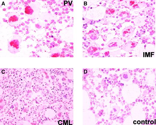 Fig. 1. Immunohistochemical detection of bFGF expression. / Immunohistochemical detection of bFGF expression in bone marrow biopsies from (A) polycythemia vera (PV), (B) prefibrotic stage of idiopathic myelofibrosis (IMF), (C) chronic myeloid leukemia (CML), and (D) reactive changes. A strong nuclear labeling exceeding that of all other bone marrow cells can be observed in PV and IMF (A,B). A considerably weaker and faint staining not highlighting the megakaryocyte nuclei occurred in CML and reactive controls (C,D). Magnification (A,B), × 400; (C), × 200; and (D), × 300 (polyclonal antibody #AF-233-NA, R&D Systems, Minneapolis, MN, diluted 1:50).