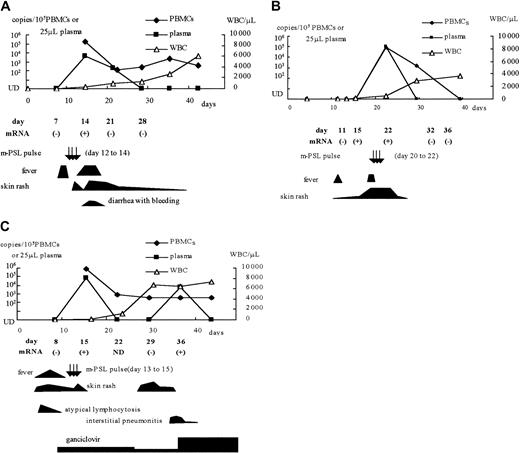 Fig. 3. Clinical symptoms and detection of HHV-6 DNA and mRNA in 3 CBSCT recipients. / (A) Patient 1; (B) patient 2; (C) patient 4. m-PSL indicates methyl prednisolone; UD, under the detectable limit; WBC, white blood cell counts.