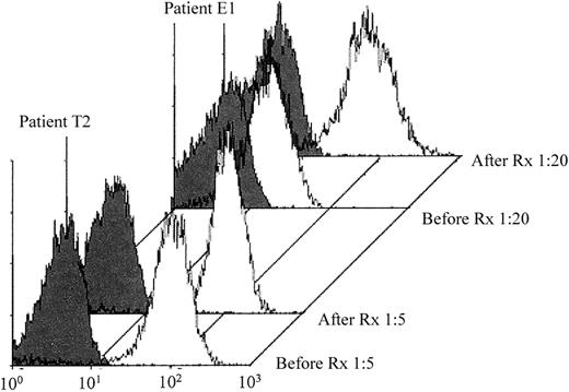 Fig. 2. Fiban-dependent antibodies were identified in pretreatment serum samples from patients T2 and E1. / Reactions of pretreatment (Before Rx) and posttreatment (After Rx) serum with platelets in the presence of drug are shown by open histograms. Negative reactions in the absence of drug are shown by the closed histograms.