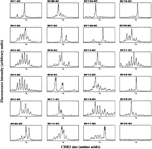 Fig. 1. Typical TCR BV-BC CDR3 size pattern from congenitally infected newborn 2. / cDNA made from total RNA extracted from CBMCs was amplified in 24 PCR reactions, each primed by a BV- and the common BC-specific oligonucleotide. The amplification products were copied in 24 run-off reactions primed by a nested fluorescent BC primer, and the labeled DNA copies were analyzed on a sequencing gel by an automated DNA sequencer. The fluorescent profiles of the 24 BV subfamilies are expressed as fluorescence intensity on the y-axis (arbitrary unit) and BV-BC size on the x-axis.