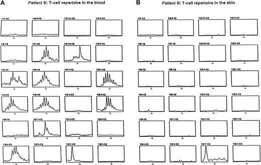 Fig. 2. Immunoscope analysis. / Patient S showed BV17 T-cell expansion in blood and skin.