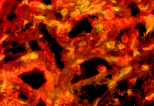 Fig. 3. Double staining of skin sections. / Patient S with an anti-BV17 antibody (fluorescein) and an anti-Ki67 antibody (cyanine).