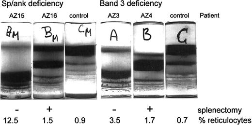Fig. 2. Density distributions of HS RBCs with spectrin/ankyrin or band 3 deficiency from unsplenectomized and splenectomized patients. / Blood from HS pairs and controls was filtered, and RBCs were separated on Percoll density gradients. Photographs of these gradients are shown. Patient identification and the actual percentage reticulocytosis are given for each patient.