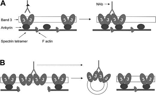 Fig. 8. Hypothesis for band 3 protein dynamics and NAb binding to HS RBCs with band 3 and spectrin/ankyrin deficiency. / Band 3 proteins exist in RBC membranes as preformed dimers and tetramers, of which the latter interact with ankyrin (for simplicity, only dimers are shown). These normally existing oligomers do not significantly bind anti–band 3 NAbs, presumably because the location of antigenic sites prevents their bivalent binding.49Lateral mobility and water loss result in the enhanced formation of band 3 clusters and favor bivalent binding of anti–band 3 NAbs. (A) Band 3–deficient RBCs. The excess of skeletal anchorage points compared to the reduced number of band 3 molecules in this deficiency prevents band 3 clusters from dissociation and release. This results in an increased number of IgG-opsonized band 3 clusters compared with healthy cells of the same age. (B) Spectrin/ankyrin-deficient RBCs. These membranes contain an excess of band 3 compared with skeletal anchorage points. Because band 3 clusters are primarily formed in areas detached from the skeleton, they will preferentially bud off as skeleton-free vesicles. This deprives the remaining spherocytes of bound opsonins and thereby may prolong their survival.