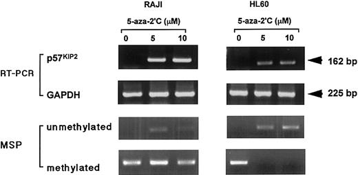 Fig. 3. Restoration of p57KIP2gene expression in RAJI and HL60 cells by 5-aza-2′-deoxycytidine (5-aza-2′C), detected by RT-PCR. / Top row of panels shows expression ofp57KIP2 gene; second row of panels, expression of GAPDH; third row of panels, detection of unmethylated status of p57KIP2 gene by MSP method; bottom row of panels, detection of methylated status ofp57KIP2 gene by MSP method. Upper arrow, 162-bp RT-PCR product ofp57KIP2 gene; lower arrow, 225-bp RT-PCR product of GAPDH gene.