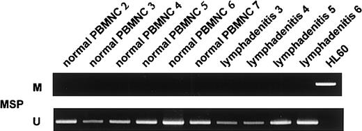 Fig. 6. Methylation analyses ofp57KIP2 gene in 4 samples of lymphadenitis and 6 of normal PBMNCs detected by the MSP method. / U shows PCR products amplified with primers specific for unmethylated DNA (MSP-U and MSP-A); M, PCR products amplified with primers specific for methylated DNA (MSP-M and MSP-A).