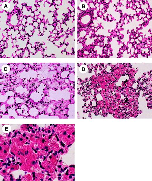 Fig. 5. Histologic observation of the lung after AMI. / Lung histology (HE stain) demonstrating pulmonary edema in α2-AP+/+ (B) mouse and α2-AP−/− (A,C,D) mice. Note, (A) an alveolar part in normal lung in α2-AP−/− mouse (×160); (B) the alveolar tissue with slight stromal thickness because of congestion in α2-AP+/+ mouse with coronary ligation (×160); (C) pulmonary edema can be observed in the alveolar space with a few erythrocytes, which means diapedesis through a wall of vessel in α2-AP−/− mouse with coronary ligation (×200); (D,E) spotty alveolar hemorrhages can be seen in α2-AP−/− mouse with coronary ligation (×160 or × 400). Heart failure cells, which are phagocytes of erythrocytes and hemosiderins, in the alveolar space (arrowheads in D).