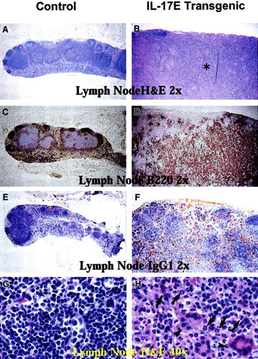 Fig. 3. Human IL-17E transgenic lymph nodes revealed lymphadenopathy. / Histologic sections of nontransgenic control littermates (left panels) and transgenic (right panels) mesenteric lymph nodes. Panels A, B, G, and H are stained with hematoxylin and eosin; panels C and D, B220-stained sections; E and F, mouse IgG1-stained sections. All panels illustrate markedly enlarged transgenic lymph nodes disrupted of their normal architecture by the infiltration of eosinophils (B, asterisk; H, arrows), B220+ B lymphocytes (D), and mouse IgG1+ plasma cells (F) as compared to the nontransgenic controls. Panel H also illustrates that transgenic lymph nodes had a substantial infiltration of multinucleated inflammatory giant cells (arrowheads). Magnification of × 2 or × 40 as indicated.