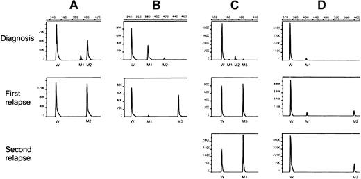 Fig. 1. Genescan analysis of FLT3/ITD levels. / The PCR assay was performed with fluorescein-labeled primers and analyzed with an automated DNA sequencer. The area under the curve was calculated for each allele using Genescan software (see “Materials and methods”). M1-M3 indicates FLT3/ITD mutations of different sizes and levels; W, wild-type FLT3. (A) Patient 22 had 2 mutations at diagnosis, with only the dominant mutation (M2) detected at relapse at an increased level.(B) Patient 23 also had 2 mutations at diagnosis, but lost the minor one (M2) while acquiring a new dominant clone (M3) at relapse. (C) Patient 24 had 3 mutations at diagnosis, losing 2 (M1 and M2) and harboring only M3 at a higher level at first relapse, which increased further at second relapse. (D) Patient 25 had a single mutation at diagnosis, acquiring another one (M2) at first relapse, which was the only mutation at second relapse.