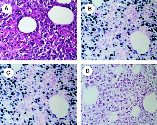 Fig. 1. In situ RT-PCR analysis of vTK expression in a representative PTLD tumor sample. / (A) Hematoxylin and eosin (H & E) stain of tumor biopsy showing diffuse infiltration by atypical large lymphocytes. (B) IS-RT-PCR detection of EBER-1 and EBER-2 mRNA. Most of the lymphoma cells in the field are positive for the expression of these abundant EBV transcripts, confirming the presence of EBV. (C) IS-RT-PCR analysis of EBV vTK mRNA. vTK expression is present in a number of lymphoma cells equivalent to those expressing EBER-1 and EBER -2. (D) RNase digestion after IS-RT-PCR analysis of vTK mRNA demonstrates that the signal present in panel C is RNA-based. Original magnification, × 400.
