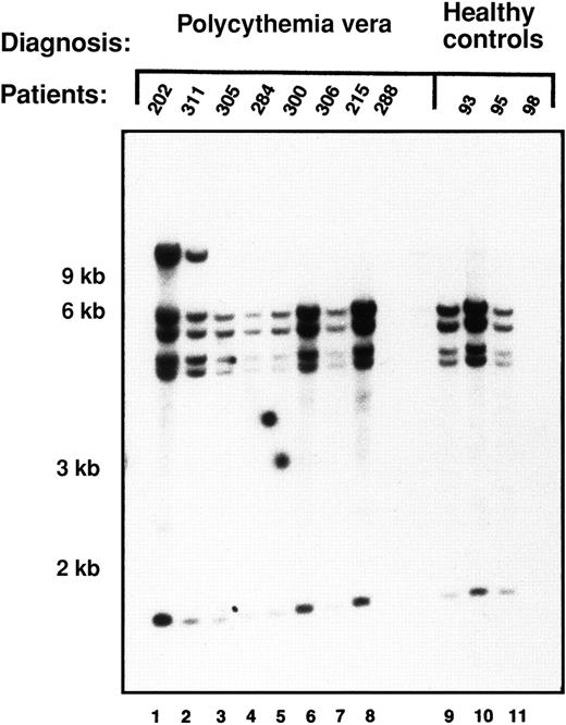 Fig. 2. The PRV1 gene is structurally intact in patients with polycythemia vera. / gDNA was extracted from purified granulocytes isolated from 8 patients with polycythemia vera and 3 healthy controls. Ten micrograms DNA was restricted with SacI and subjected to Southern blotting. The membrane was probed with a 1.4-kb fragment of the PRV-1 cDNA. Positions of the size markers are indicated on the left.
