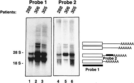 Fig. 3. Multiple PRV-1 mRNA species are generated by alternative polyadenylation. / Northern blot analysis of granulocyte RNA from 3 patients with polycythemia vera. PRV-1 cDNAs of various lengths were amplified by 3′ RACE and sequenced. The blots were hybridized with 2 different cDNA probes as indicated: probe 1 is derived from the coding region of the cDNA, whereas probe 2 is derived from the 3′ untranslated region of a RACE product. The positions of the 28S and 18S ribosomal RNAs are indicated.