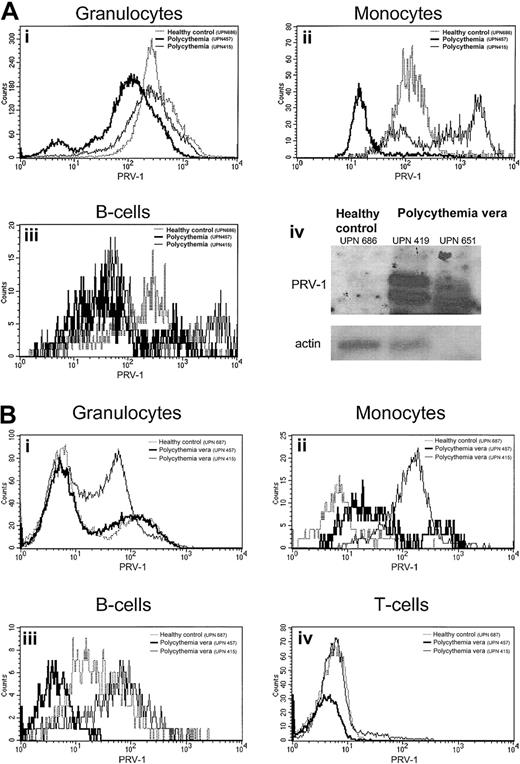 Fig. 7. PRV-1 protein expression in the peripheral blood and bone marrow. / (A) Peripheral blood from a healthy control (UPN 686, dotted line) and 2 patients with polycythemia vera (UPN 651, thin solid line, and UPN 419, thick solid line) was stained with the lineage-specific antibodies CD13, CD14, CD19, CD45 as well as an antibody against PRV-1. Peripheral blood granulocytes (i), monocytes (ii), and B cells (iii) were identified by their surface markers and analyzed for PRV-1 expression. Panel A-iv depicts a Northern blot of RNA from purified granulocytes of the same individuals hybridized to the PRV-1 cDNA (top) or to β-actin (bottom). (B) Bone marrow aspirates of a healthy bone marrow donor (UPN 687, dotted line) and 2 patients with polycythemia vera (UPN 457, thick solid line, and UPN 415, thin solid line) were stained with the lineage-specific antibodies CD3, CD13, CD14, CD19, CD45 as well as an antibody against PRV-1. Bone marrow granulocytes (i), monocytes (ii), B cells (iii), and T cells (iv) were identified by their surface markers and analyzed for PRV-1 expression.