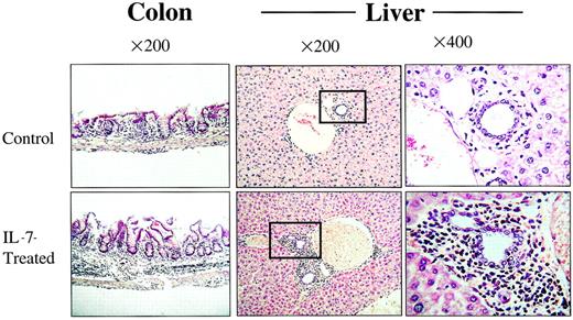 Fig. 3. The rhIL-7 recipients show increased histologic evidence of GVHD. / Tissues shown were taken from representative animals that received 5 × 106 LN cells and sham (top) or rhIL-7 (bottom). Increased inflammation in the colonic submucosa and portal triad is noted in IL-7–treated mice and is consistent with GVHD. Boxes indicate the areas shown at greater magnification in the far right panels.