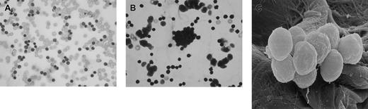Fig. 1. Ex vivo agglutination of in vivo antibody-coated chronic lymphocytic leukemia cells (CLLs). / Cells incubated in normal saline (control) are shown in panel A, cells incubated in gelofusin showing TCA are shown in panel B, and SEM appearance of agglutinated CLL cells is shown in panel C. Original magnification: × 500.