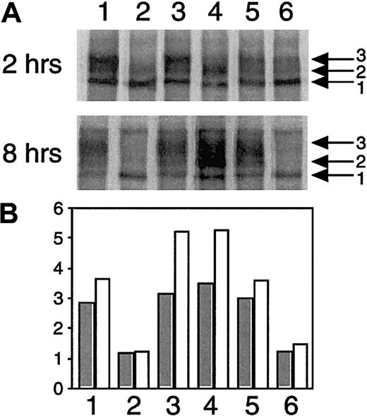 Fig. 5. Impaired intracellular processing of FV mutants. / The wt-FV and the FV mutants in cell lysates at 2 hours' chase (upper panel) and 8 hours' chase (middle panel) were subjected to 4% SDS-PAGE under reducing conditions. It should be noted that the gel of 8 hours' chase was overexposed to make faint bands visible. Lane 1, wt-FV; lane 2, mutant Q; lane 3, mutant Met385Thr; lane 4, mutant His1299Arg; lane 5, mutant Met1736Val; lane 6, mutant Asp2194Gly. The radioactivity of the primary translated peptide (band 1) and the posttranslational intermediates (bands 2 and 3) in each lane was quantitated, and the ratios of the posttranslational intermediates over the primary translated peptide (bands 2 and 3/band 1) were calculated (lower panel). Closed and open histograms indicate the ratios at 2 hours' chase and 8 hours' chase, respectively.
