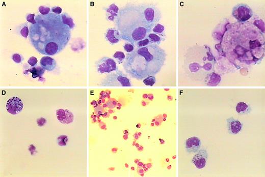 Fig. 7. Morphologic analysis of NK/DC clusters from NB patients. / Cytospins were carried out with cells harvested in the different cocultures described in the Figure 5 legend (1:1 ratio, day 7), stained with May-Grünwald-Giemsa coloration and observed under optical microscopy: NK cells/iDCs (panel A); NK cells/iDCs with LPS (panels B and E); NK cells/mDCs (panel C); NK cells alone without IL-2 (panel D); and NK cells alone with IL-2 (1000 IU/mL) (panel F). Original magnification was × 1000 for all panels, except that it was × 400 for panel E. These observations are representative of 2 experiments.
