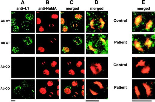 Fig. 3. Immunolocalization of 4.1R and NuMA in erythroid and lymphoid cells. / Column A shows 4.1 isoform distribution; column B, NuMA distribution; column C, colocalization of various 4.1 isoforms and NuMA; column D, higher magnification of the mitotic cells shown in column C; column E, results obtained with the use of lymphoid cells. In all of these, only the high magnifications are shown. Bar indicates 5 μm. AbCT gave a positive reaction with 4.1R in the control and with CO.2 in the patient. AbCO recognized only the missense sequence of CO.1 in the patient (note the complete absence of fluorescence in the control, lane 3). Normal 4.1R (control), and CO.2 and CO.1 (homozygote) showed a punctate distribution within the cytoplasm and the nucleus of interphasic and dividing cells. The 4.1R partly concentrated at the center of each mitotic pole in dividing cells. AbNuMA gave a positive reaction in both the control and the homozygote. NuMA had a diffuse distribution in the nucleus in interphasic cells and concentrated almost entirely in the mitotic spindle poles in dividing cells. The 4.1R and CO.2, on the one hand, and AbNuMA, on the other, colocalized in control and homozygote mitotic cells, while CO.1 was missing from the spindle poles (AbCO plus AbNuMA; lane 4, columns C, D, and E).