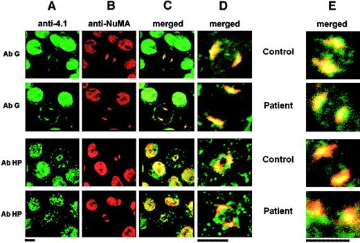 Fig. 6. Immunolocalization of 4.1G and NuMA in the nuclei of erythroid and lymphoid cells. / Similar results were obtained in erythroid progenitors (columns A-D) and lymphoid cells (column E): Column A shows 4.1 isoform distribution; column B, NuMA distribution; column C, colocalization of various 4.1 isoforms and NuMA; column D, higher magnification of the mitotic cells shown in column C; column E, results obtained in lymphoid cells. In all of these columns, only the high magnifications are shown. AbHG13 (AbG) gave a positive reaction in both control and patient CO cells, and it colocalized with NuMA at the mitotic spindle poles. AbHP reacted with 4.1R (control) and indiscriminately with CO.2 and CO.1 (homozygote). This antibody reproduced the punctate distribution within the cytoplasm and the nucleus of interphasic cell seen in Figure 3. Even though AbHP recognized both isoforms, CO.1 and CO.2, which are shortened at their C-termini, colocalization with NuMA necessarily stems only from CO.2 (Figure 3). Bars indicate 5 μm.