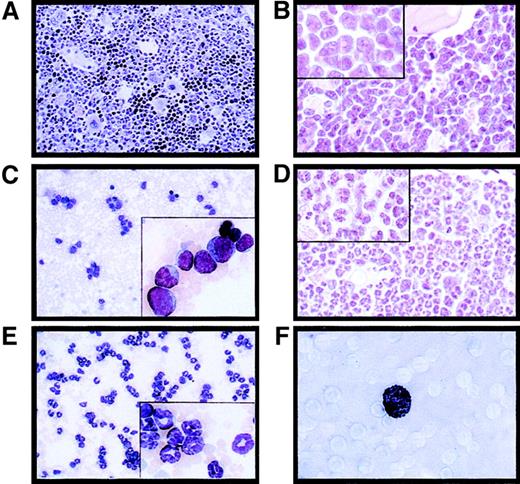 Fig. 3. PML-RAR induces an APL-like phenotype, and RA leads to terminal differentiation. / Histologic analysis of the bone marrow from an untreated control mouse (A, original magnification × 400), a leukemic mouse reconstituted with PML-RAR expressing cells (B, original magnification × 600, inset × 1000), and a leukemic mouse after 7 days of RA treatment (D, original magnification × 600, inset × 1000). May-Grünwald-Giemsa staining of peripheral blood smears from a PML-RAR mouse at the leukemic stage (C, original magnification × 400), and after 5 days of RA treatment (E); in the insets, a larger magnification of the same figures (original magnification × 1000). (F) Sudan black staining of APL blasts from a PML-RAR leukemic mouse (original magnification × 1000).