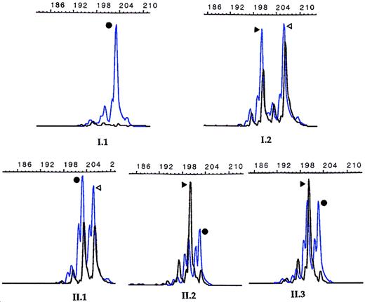Fig. 2. X-chromosome inactivation analysis. / Results obtained at the HUMARA locus. The blue peaks and the black peaks correspond to PCR products before and after HpaII digestion, respectively. The length of the PCR fragments are noted on the top of each histogram, and the father had a 203-bp fragment in his only X allele, while the mother had both a 200-bp and a 206-bp fragment in her 2 alleles. The mother's 206-bp fragment was transmitted to the healthy daughter (II.1), while the mother's other X-chromosome containing the 200-bp fragment went to the twins (II.2, II.3). The 2 black peaks in approximately equal proportion are seen in X-chromosomes randomly inactivated from females I.2 and II.1, whereas only one black peak corresponding to the mother's 200-bp inactivated allele is observed in the twins (II.2 and II.3), indicating a skewed X-chromosome inactivation toward the maternally 200-bp–derived allele.